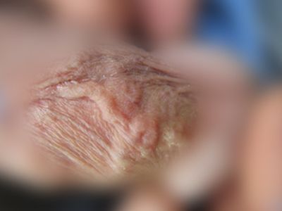阴茎淋巴管硬化症（Lymphangiosclerosis）.jpg