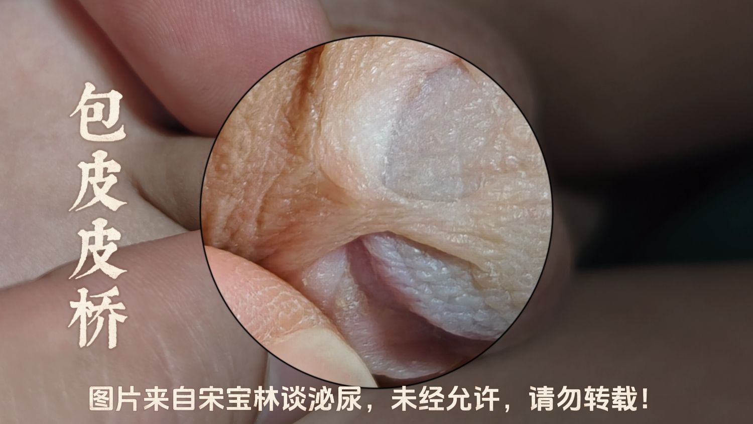 包皮皮桥.jpg